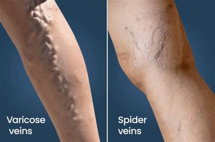 Are spider veins ever covered by insurance?