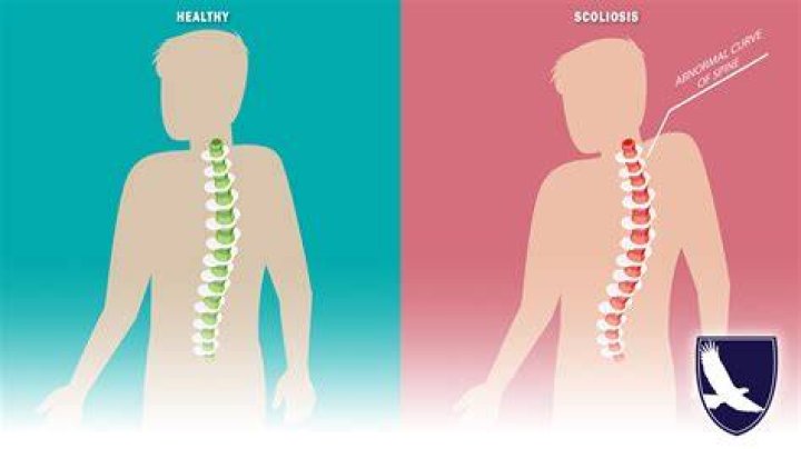 Can I get Social Security disability for scoliosis?