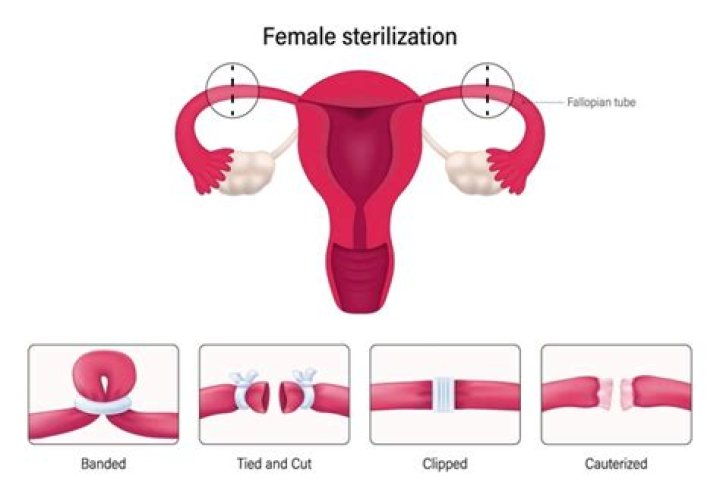 Can tubal ligation be medically necessary?