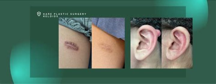 Does Medicare cover keloid removal?