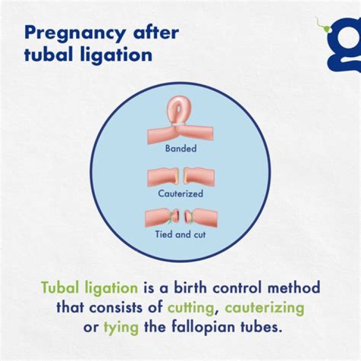 How can I get pregnant without tubal ligation reversal?