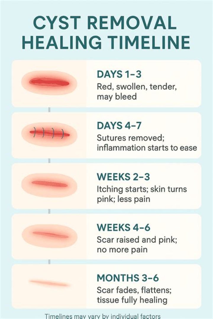 How much does it cost for a cyst to be removed?