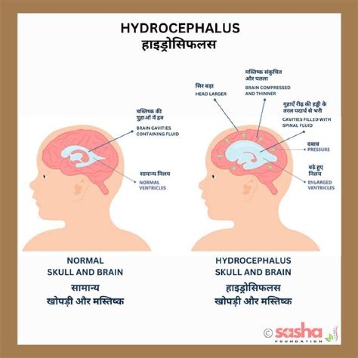 Is hydrocephalus a permanent disability?