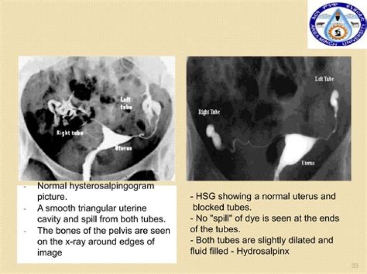 Is Hysterosalpingogram covered by insurance?