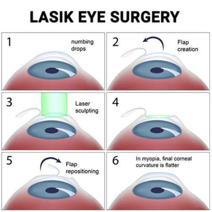 Is LASIK covered by NHS?