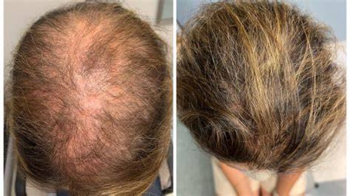 Is there a pill to stop hair growth?